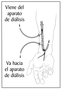 Ilustración de un brazo con una fístula arteriovenosa.