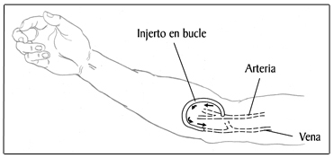 Ilustración de un Injerto en bucle.