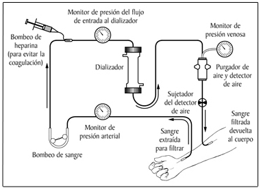 Ilustración de las partes de un dializador.