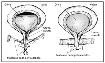 Dos ilustraciones anatómicas de la vejiga. La vejiga en la izquierda tiene músculos débiles del suelo pélvico que permiten que la orina escape. Se etiqueta la vejiga, la orina y la uretra (abierta) y músculos débiles de la pelvis. La vejiga en la derecha tiene músculos fuertes del suelo pélvico que no permiten que la orina escape. Se etiqueta la vejiga, la orina, la uretra (cerrada) y músculos pélvicos fuertes.