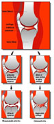 link to description of cross section of normal and arthritic knee joints