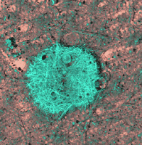 Image of a blue-green fibrous mass in the brain.
