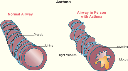  Illustration showing anormal airway and an airway in a person with asthma.