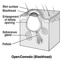 Illustration of lesion, Open Comedo (Blackhead)