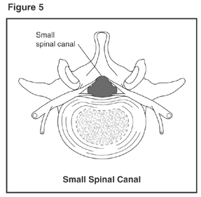 Small spinal canal