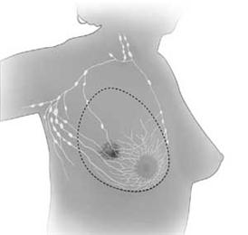 Total (simple) mastectomy; drawing shows removal of the breast and lymph nodes.