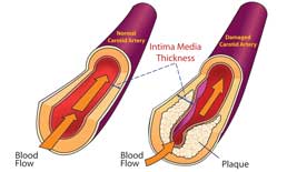 Intima media thicknesses in healthy and damaged arteries