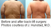 HealthDay news image for article titled: Bye, Bye Back Fat?
