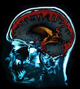 Las noticias de HealthDay imaginan para el artículo titulado: Una técnica de imagen muestra por qué el cerebro  se esfuerza más  después de una lesión cerebral