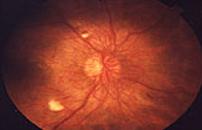 Imagen de un ojo con retinopatía diabética