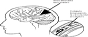 Area afectada del cerebro; Coágulo bloqueando la circulación al cerebro
