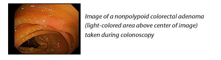 Image of a nonpolypoid colorectal adenoma (light-colored area above center of image) taken during colonoscopy.