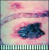 Picture of a melanoma.