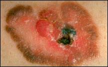 Picture of a melanoma.