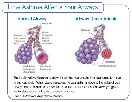 How Asthma Affects Your Airways