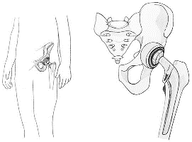 Illustration of an artificial hip joint