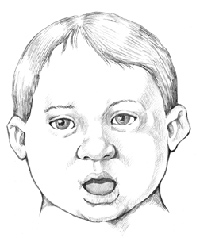 Illustration of a child with Down syndrome