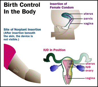 [illustration of Norplant insertion, insertion of female condom, and IUD in position]