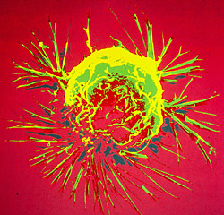 picture of breast cancer cell