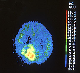 Positron Emission Tomography (PET) scan of brain with tumor