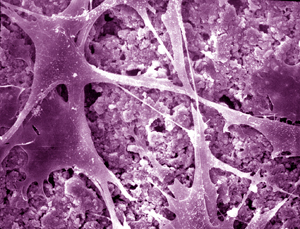 colorized scanning eletron micrography shows bone cells attaching to new type of bone cement made of calcium phosphate