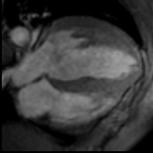 The digital movie shown on this page is a 4-chamber view of the left ventricle in a patient with aortic insufficiency and left ventricular hypertrophy