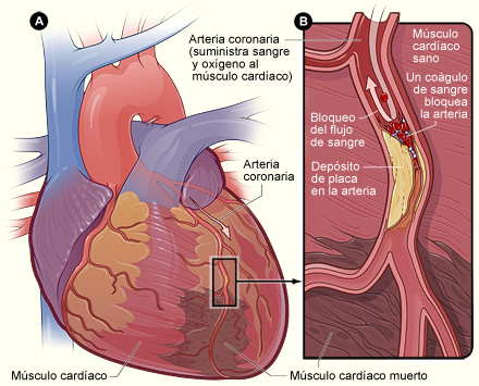 La figura A es un esquema de un corazón y de una arteria coronaria que están lesionados (músculo cardíaco muerto) a causa de un ataque cardíaco. La figura B es un corte transversal de la arteria coronaria con depósito de placa y un coágulo de sangre.