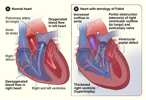 Illustration shows the normal structure of the heart and defects of tetralogy of Fallot.