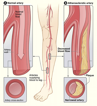 Illustration showing the location of leg arteries that can be affected by peripheral arterial disease