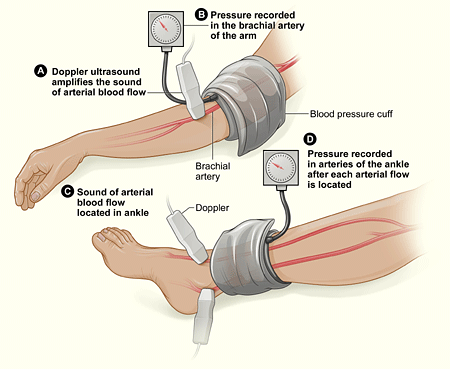Illustration showing the ankle-brachial index (ABI) test