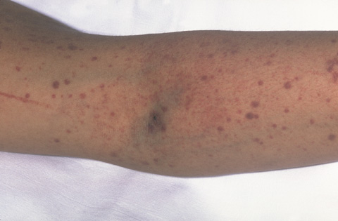 Photograph showing purpura (bruising) on the skin