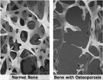 photograph: 'Normal Bone' shows a dense network of fibers; 'Bone with Osteoporosis' shows very sparse, disconnected fibers