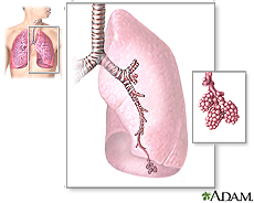 Illustration of the major features of the lungs, including the bronchi, the bronchioles and the alveoli