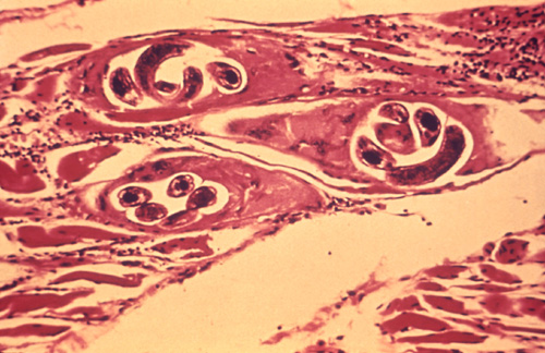 Roundworm in Human Muscle