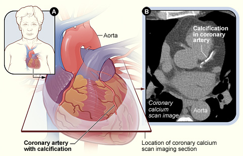 The illustration shows a coronary artery with calcifications and a coronary calcium scan image.