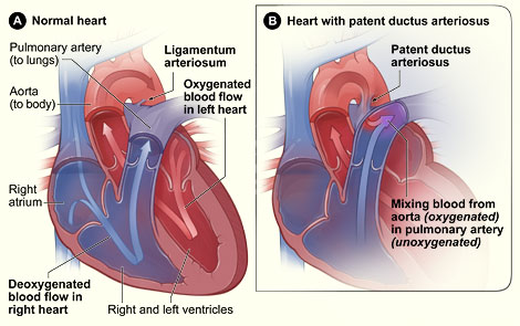 Illustration showing normal anatomy and blood flow and a heart with patent ductus arteriosus.