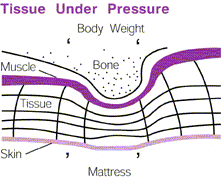  The image 'Tissue Under Pressure' shows how Body Weight forces Bone against Muscle which in turn applies pressure to the underlying Tissues of the Skin.