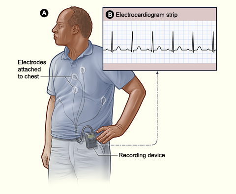 Illustration showing how a Holter or event monitor attaches to a patient.