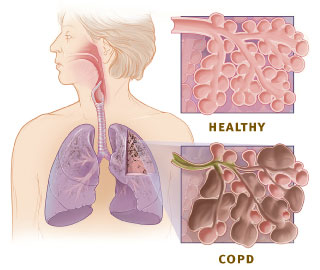 The illustration show the respiratory system and cross-sections of healthy alveoli and alveoli with COPD.