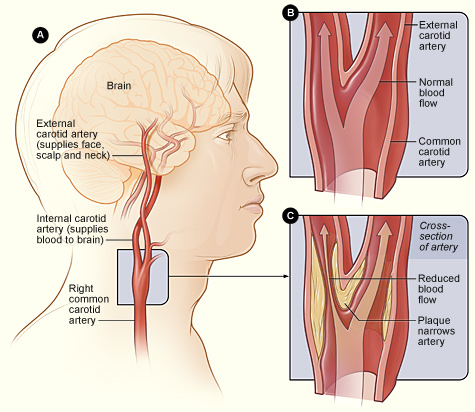 Illustration showing the location of the right carotid artery in the head and neck, a cross-section of a normal carotid artery, and a carotid artery that has plaque buildup and reduced blood flow.