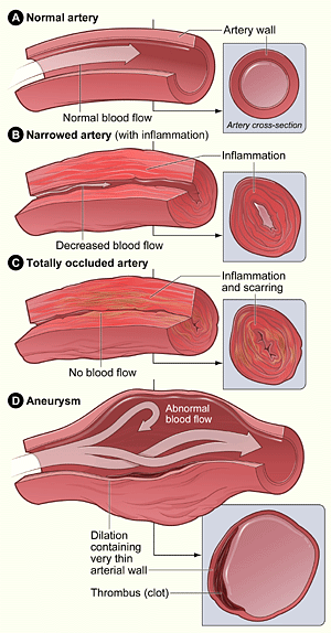  Illustration of a normal artery, narrowed artery,  totally occluded artery, and aneurysm