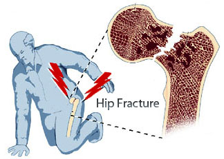 hip fracture image