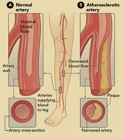 Illustration: [Artery with normal blood flow (Figure A) and an artery containing plaque buildup (Figure B)]