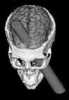 This computer-generated graphic shows how, in 1848, a 3-foot long, pointed rod penetrated the skull of Phineas Gage, a railway construction foreman. The rod entered at the top of his head, passed through his brain, and exited his skull by his temple. Gage survived the accident but suffered lasting personality and behavioral problems.