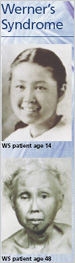 Photohgraphs of a young and old Werner's Syndrome patient
