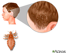 Illustration of head lice