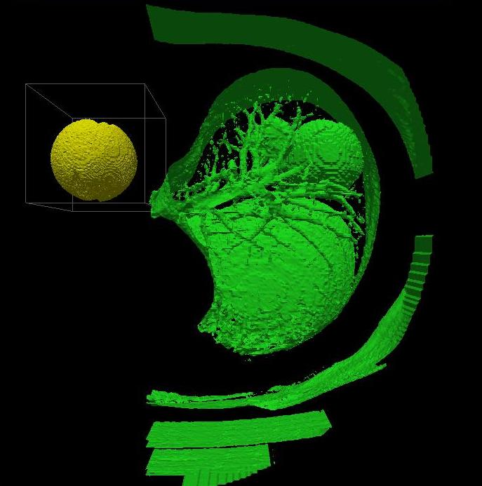 Isosurface of the new image created by embedding the FDA tumor in the lung data