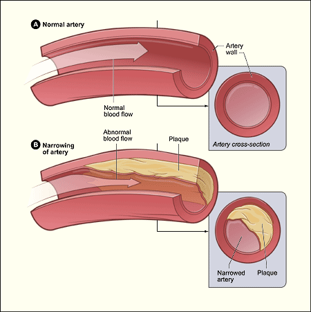 The illustration shows a normal artery with normal blood flow and an artery containing plaque buildup.