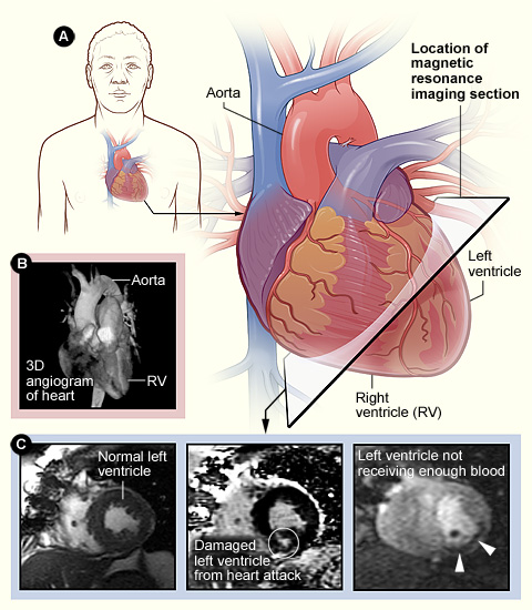 Illustration and photos of Cardiac MRI