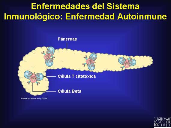 Enfermedades del Sistema Inmunológico: Enfermedad Autoinmune
